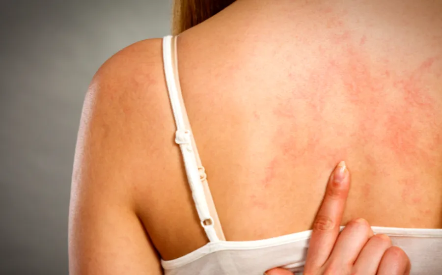 urticaria_padecimiento
